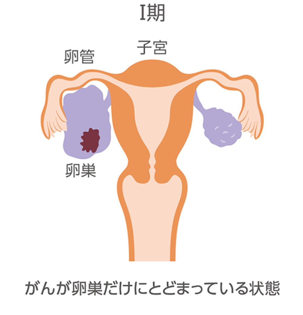 卵巣がんの進行期ごとの広がり方をまとめたイラスト