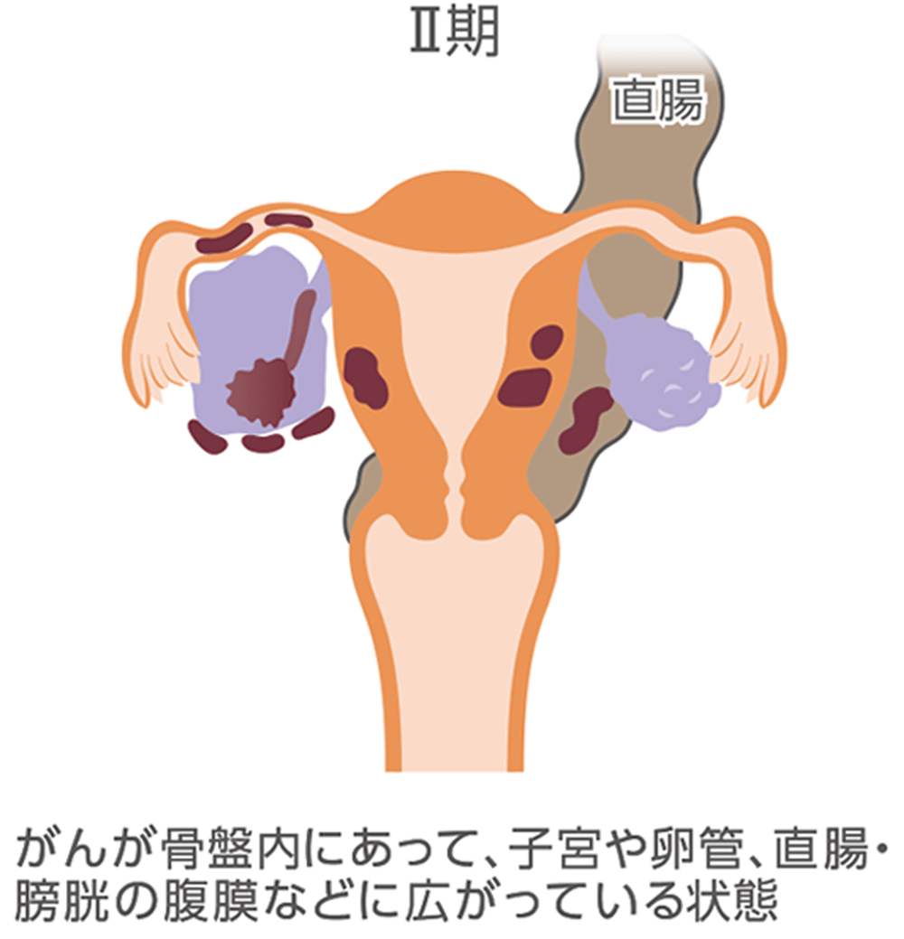 卵巣がんの進行期ごとの広がり方をまとめたイラスト