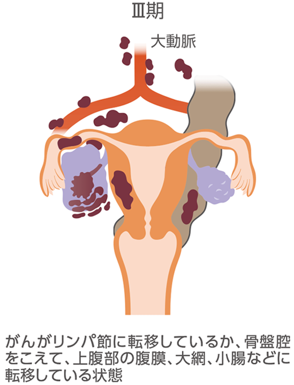 卵巣がんの進行期ごとの広がり方をまとめたイラスト