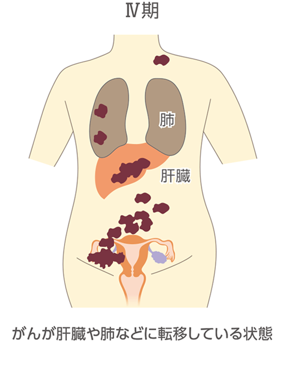 卵巣がんの進行期ごとの広がり方をまとめたイラスト