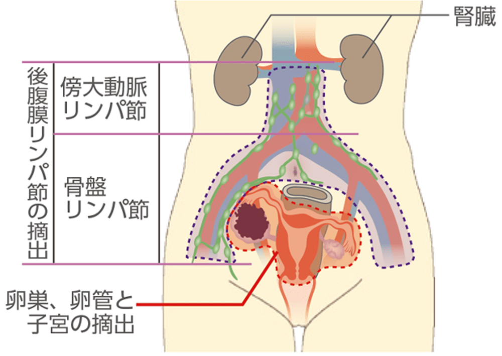 卵巣がんの手術範囲をまとめたイラスト