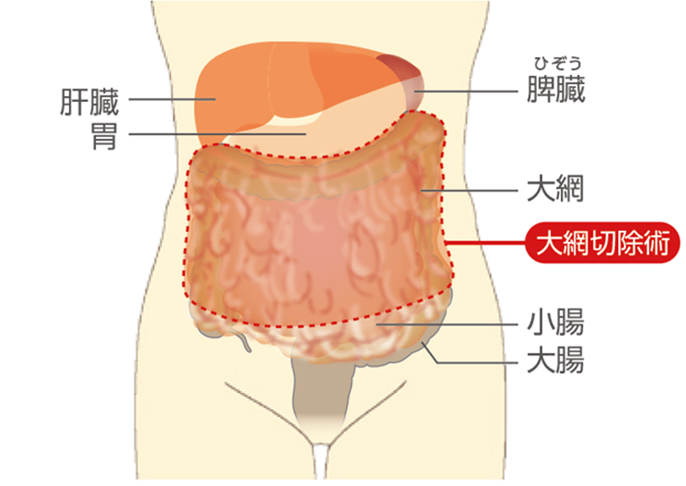 卵巣がんの手術範囲をまとめたイラスト